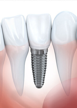 Offrez-vous des implants dentaires et implant dentaire unitaire de qualité - Trois cliniques offrent des implants dentaires et implants dentaires unitaires soit à Bromont et Cowansville ainsi qu'à Sutton