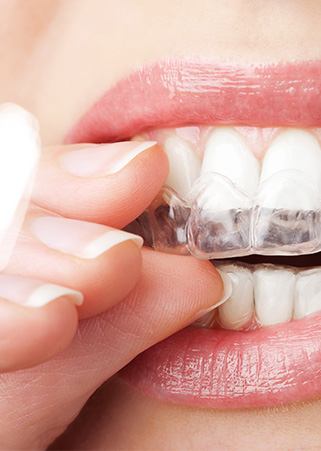 Invisible braces - Invisalign - Invisible dental pin - ExpertDent